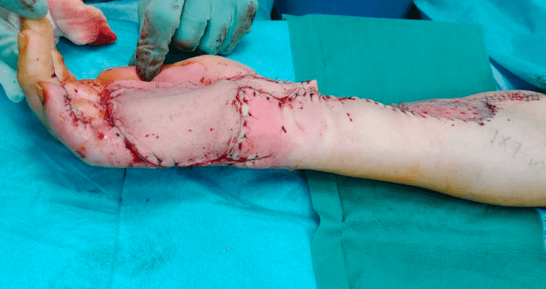 Close-up of arm surgical reconstruction process.