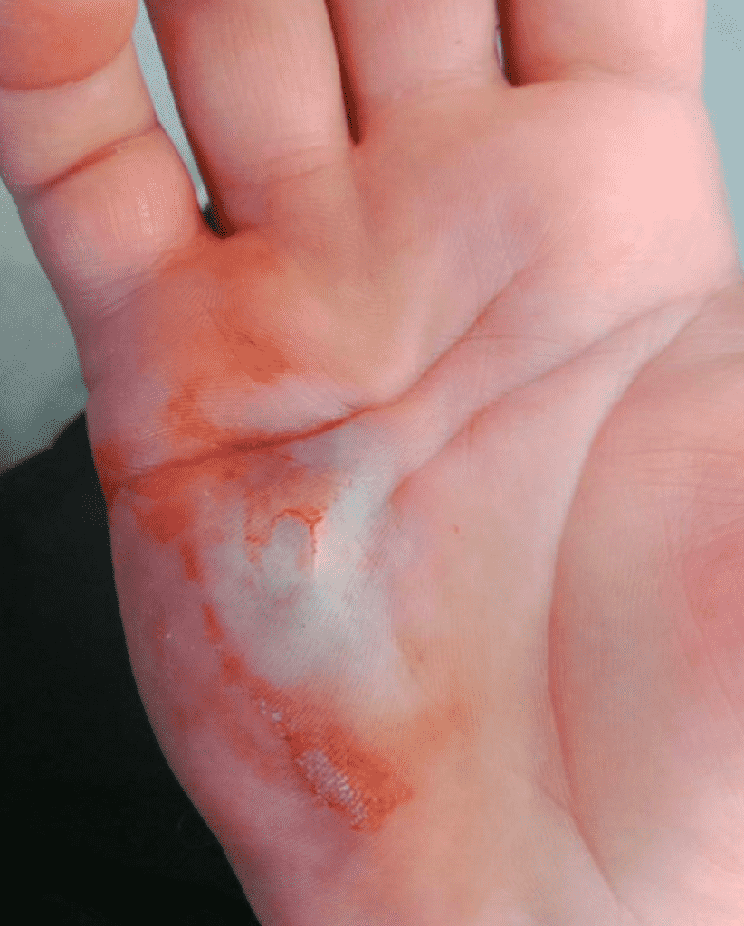Hand with cut and bruising on palm