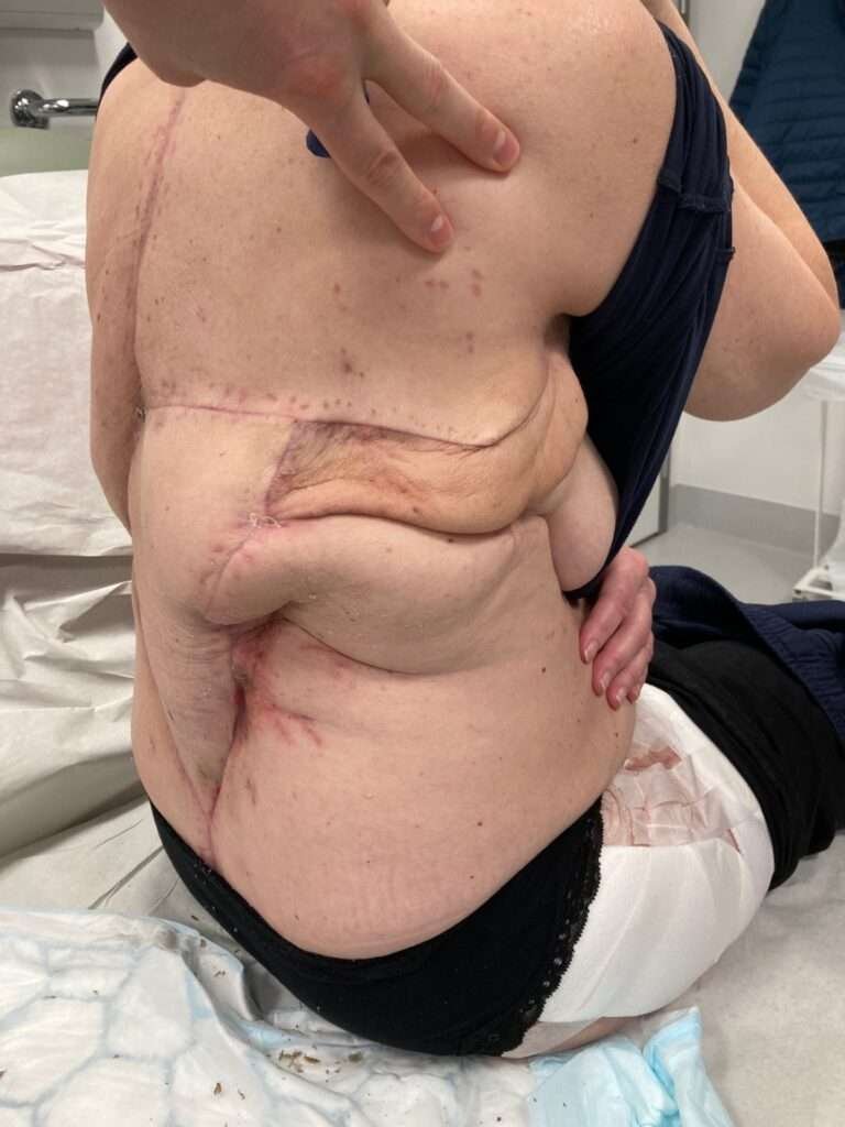 Person with surgical scars on torso in medical setting.