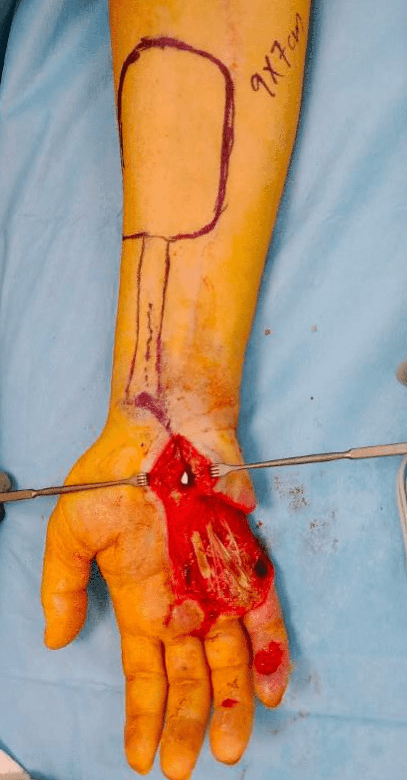 Surgical hand with outlined incision site.