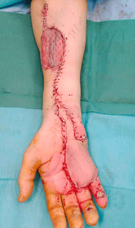 Forearm with skin graft and stitches post-surgery.