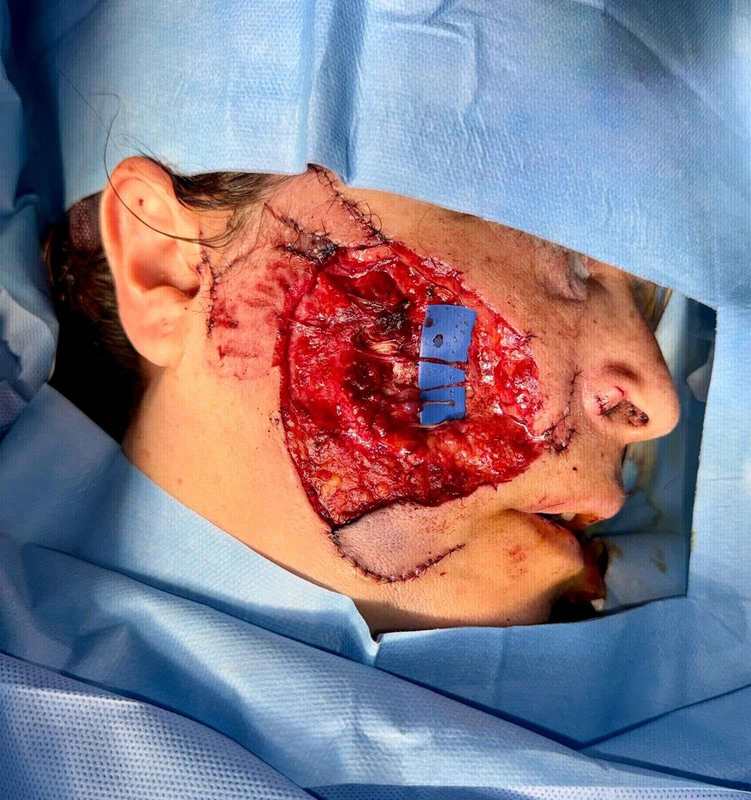 Surgical cheek wound with sutures and blue medical tool.