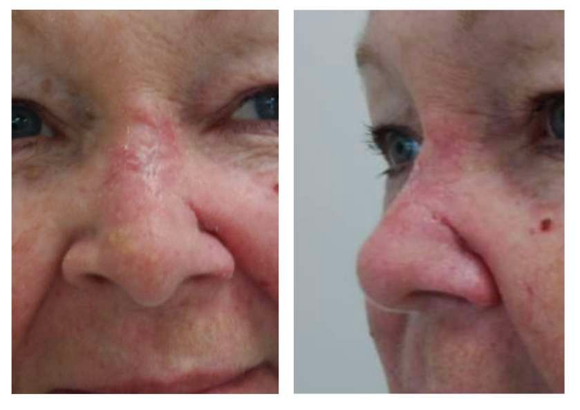 Close-up images of nose with skin irritation.