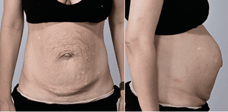 Side-by-side of abdomen, before and after results.