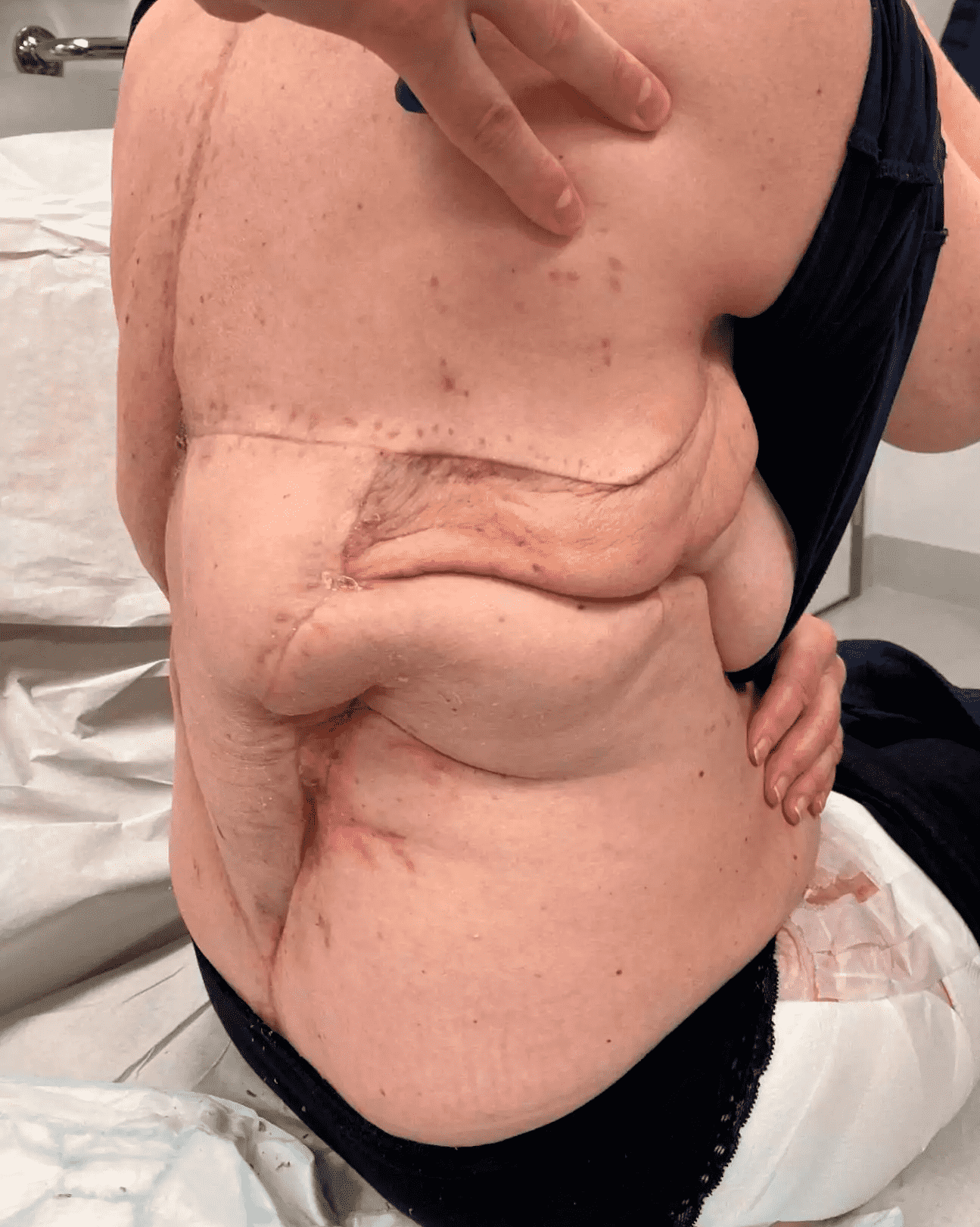 Post-surgery side view of torso and hip.