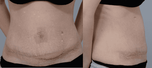 Abdominal scar before and after healing comparison.