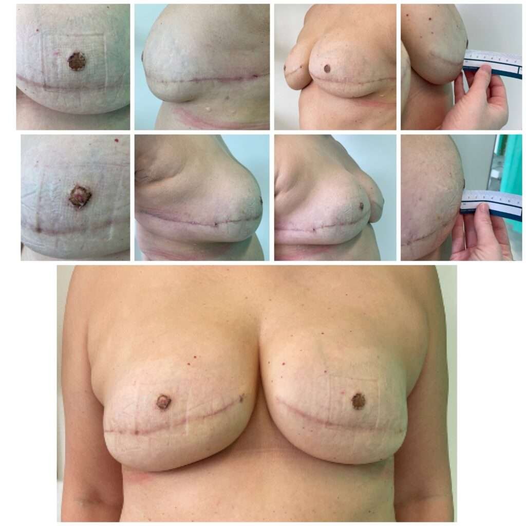 Breast augmentation post-surgery scars and healing process
