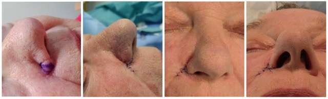 Nose surgery stages showing before and after results.
