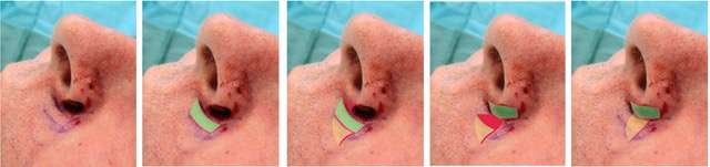 Nasal reconstruction stages after skin graft surgery.