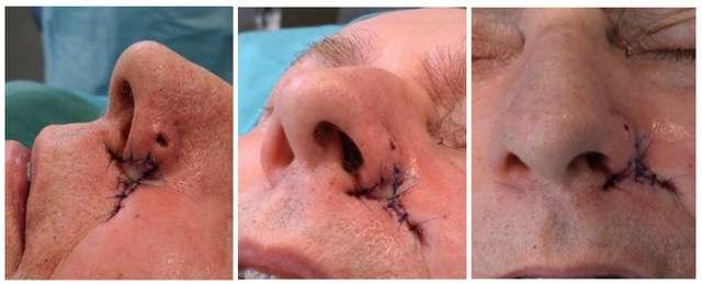 Close-up of nose surgery stitches in three images.