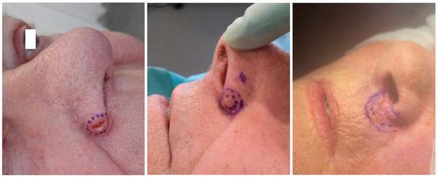 Skin lesion marked on nose for medical procedure