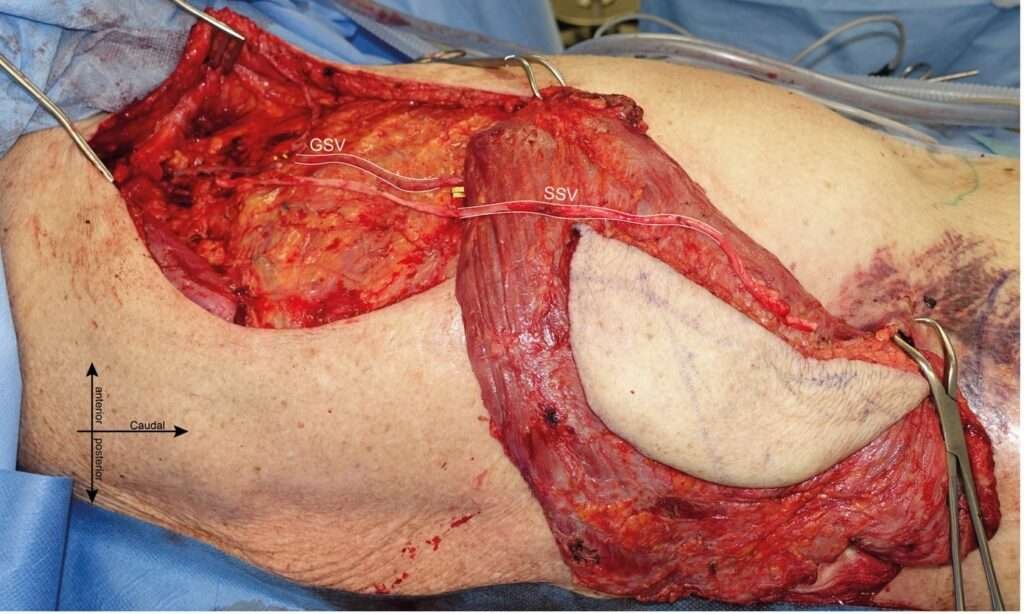 Detailed view of surgical dissection with labeled veins.