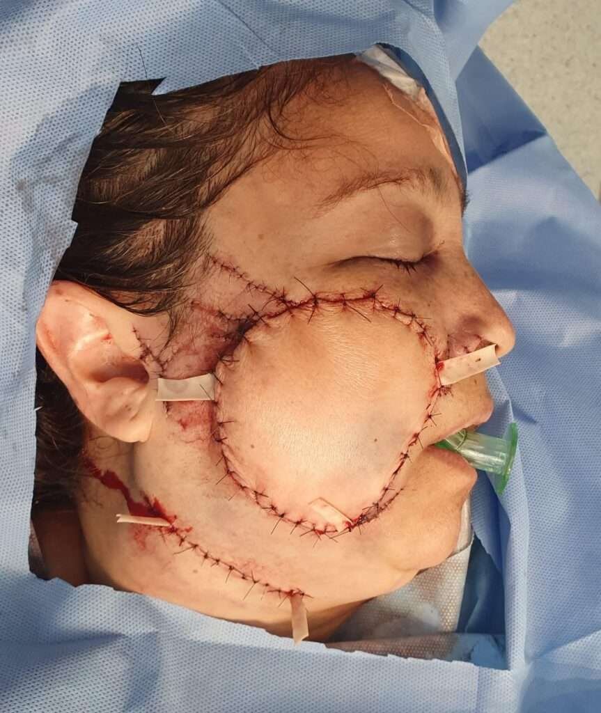 Patient post-facial surgery with stitches and bandages.