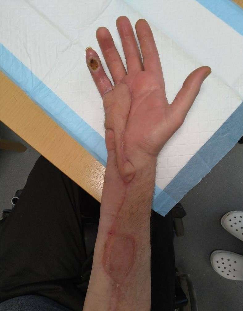 Scarred arm and hand on medical pad.