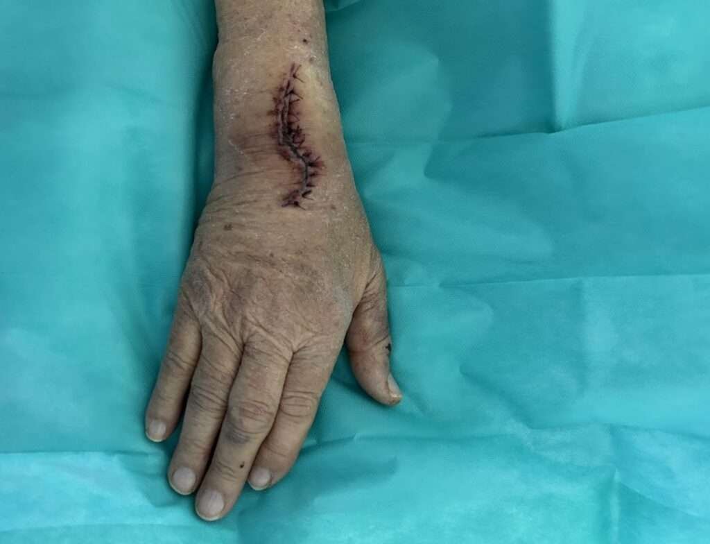 Stitched wound on forearm, teal surgical drape.