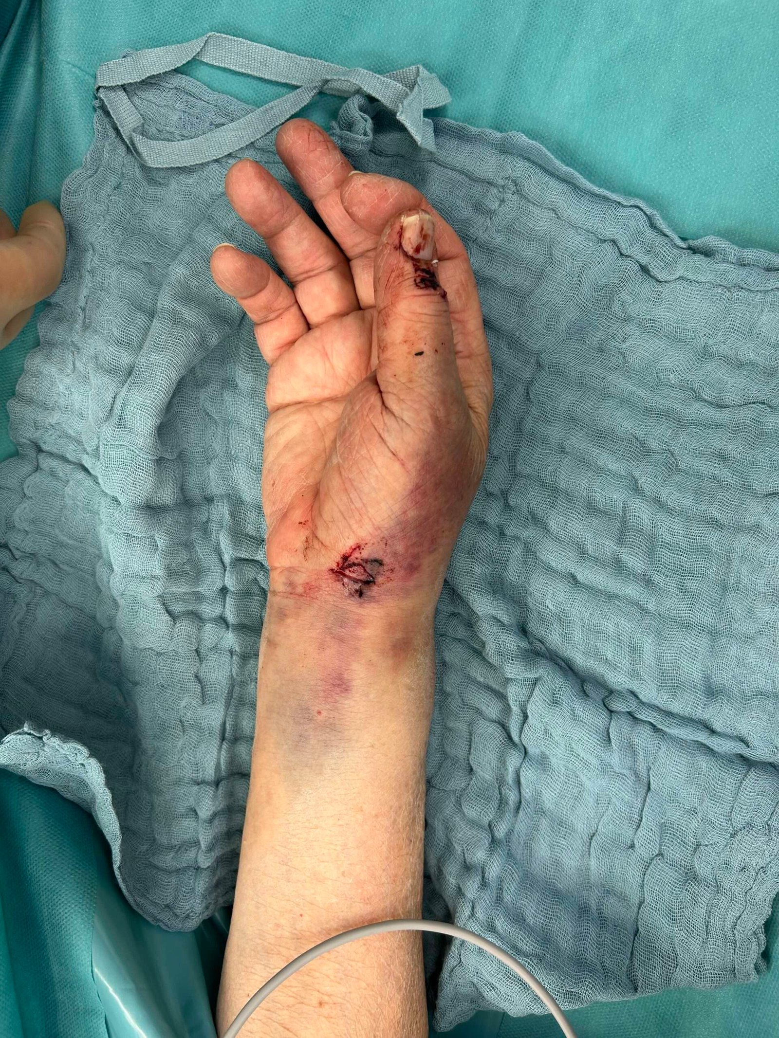 Injured arm with stitches and bruising on blue cloth.