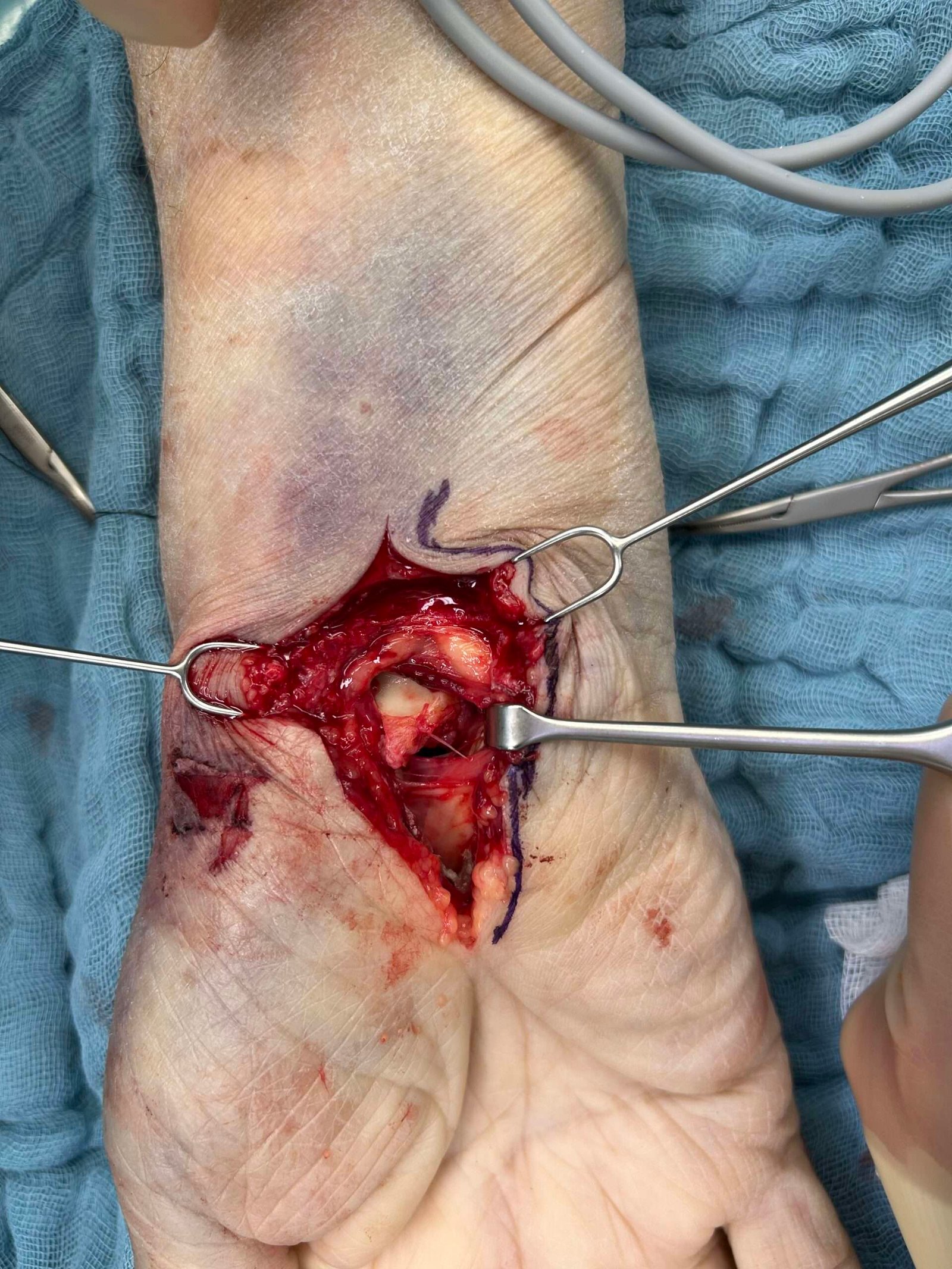 Close-up of surgery on a human wrist.