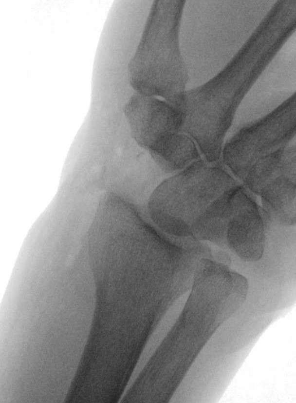 Human wrist X-ray showing bone structure.