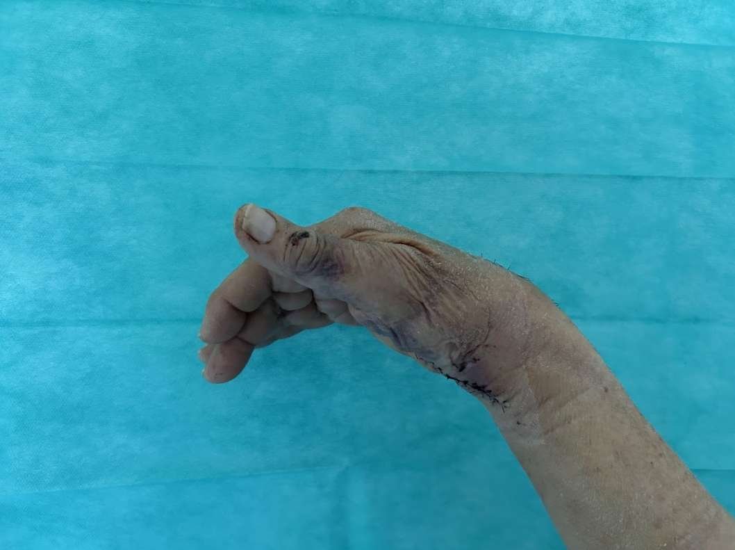Close-up of hand with surgical stitches on thumb.