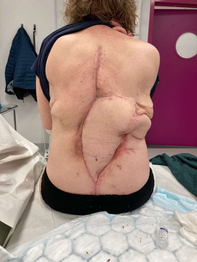 Post-surgery scars on a person's back in clinic.