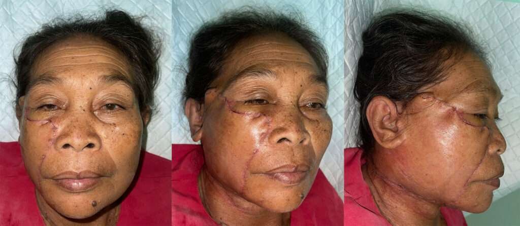 Woman's facial surgery stitches from three angles