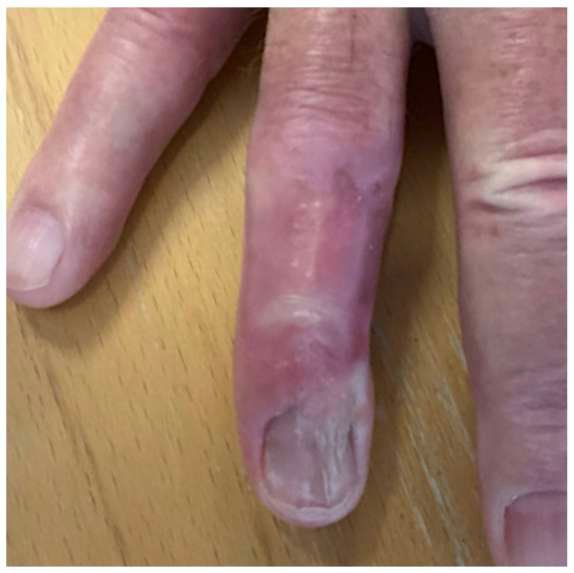 Close-up of inflamed finger on wooden surface.