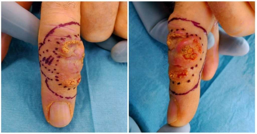 Marked finger lesion with skin discoloration