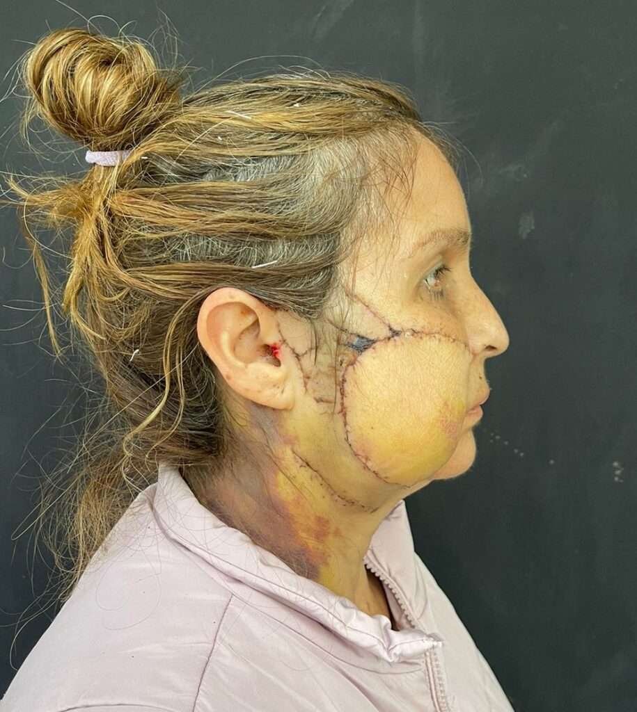 Woman with facial surgery scars from side view.