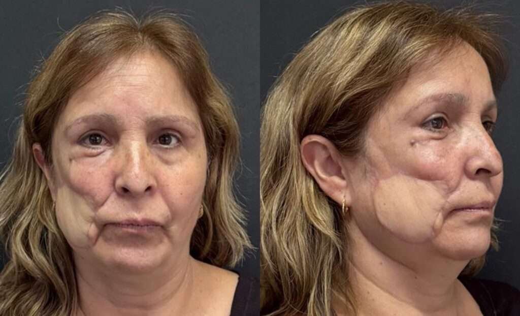 Woman with facial asymmetry in front and side views.