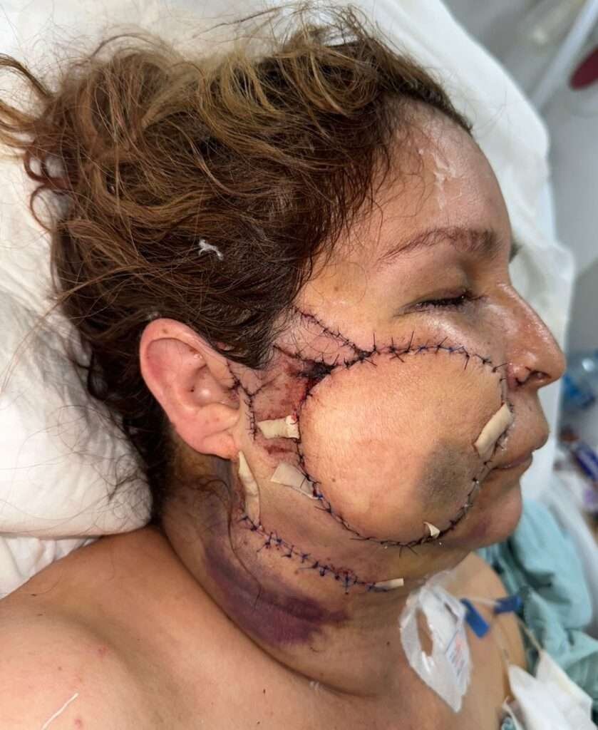 Person with facial surgery stitches and bandages.