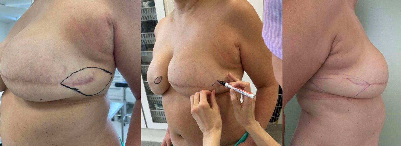 Breast surgery planning with marker drawings.