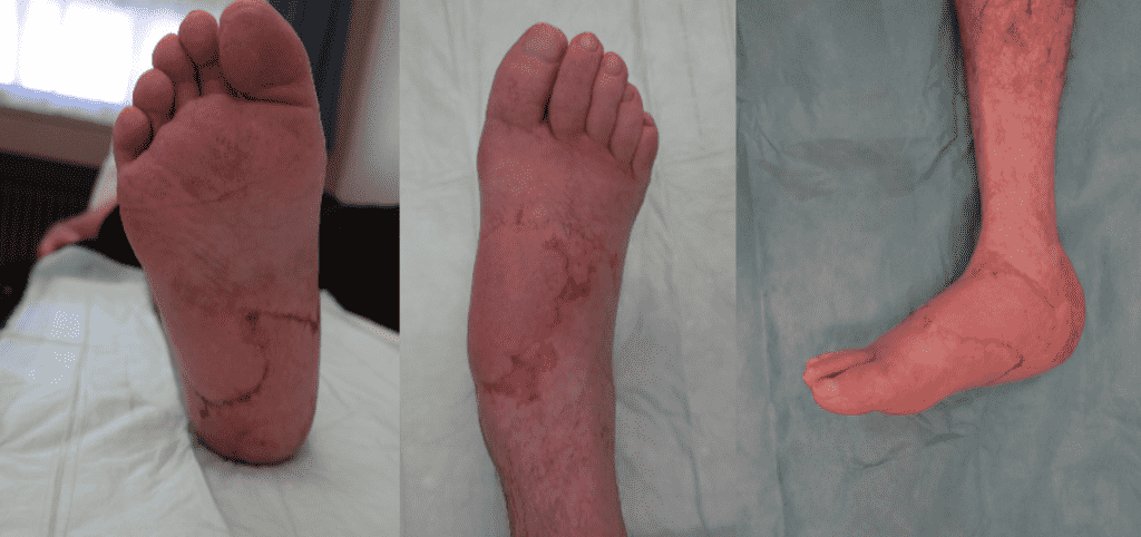 Swollen foot with visible redness and scarring