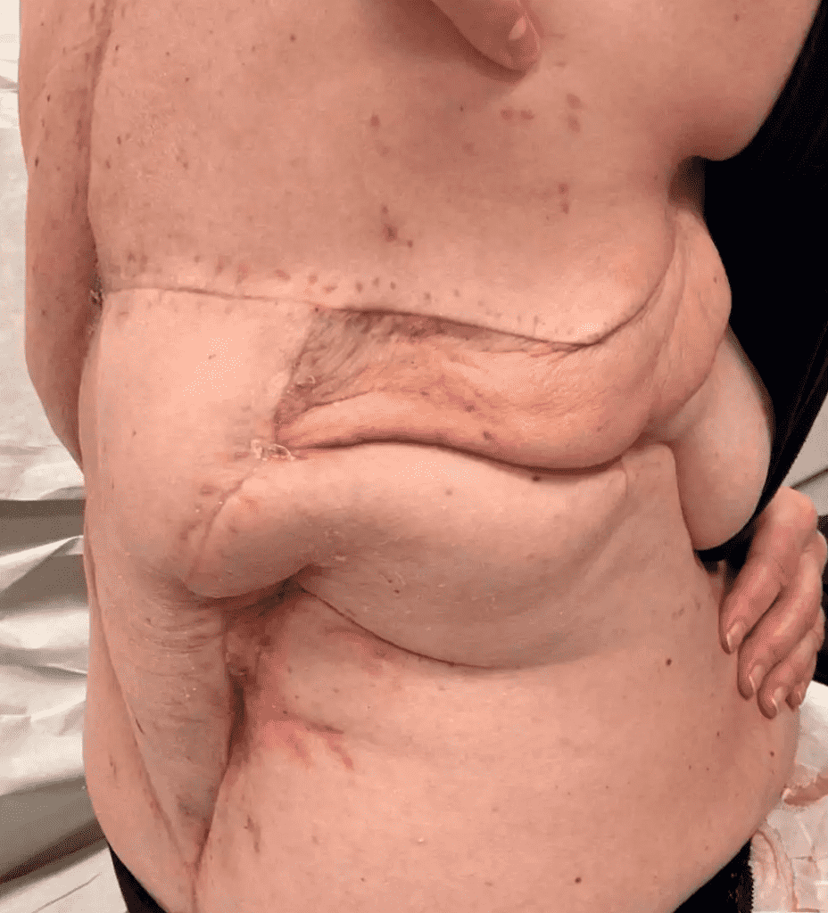 Close-up of surgical scars on a person's torso.