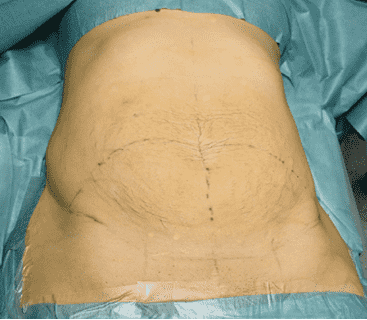 Abdomen prepared for surgical procedure with markings.