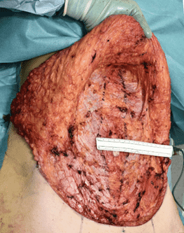 Large surgical wound with measuring tool visible.